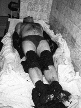 Горячие компрессы творят чудеса
